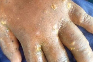 Skin disease outbreak