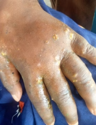 Skin disease outbreak
