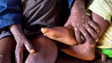 Mpox cases surge in ghana