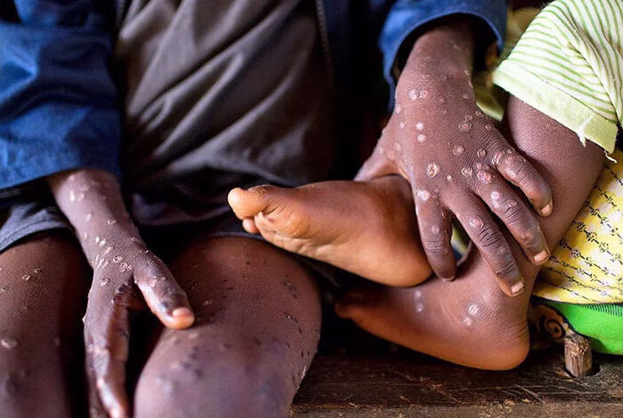 Mpox cases surge in ghana